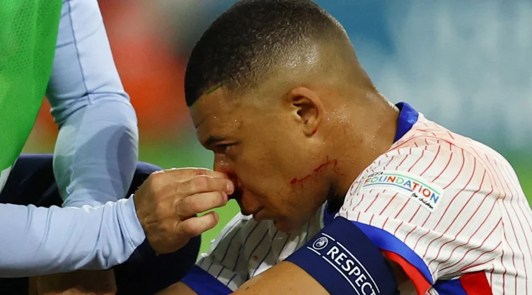 Mbappé con la nariz rota
