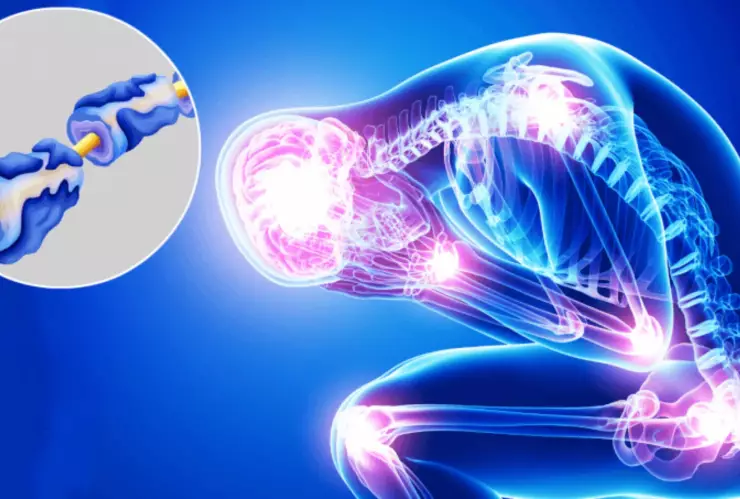 sindrome de guillian barre sintomas