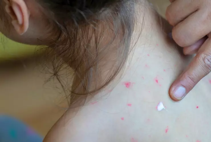 Síntomas del sarampión