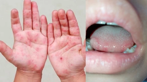 Coxsackie en niños: qué es, cómo se transmite, síntomas y medidas para evitar el contagio