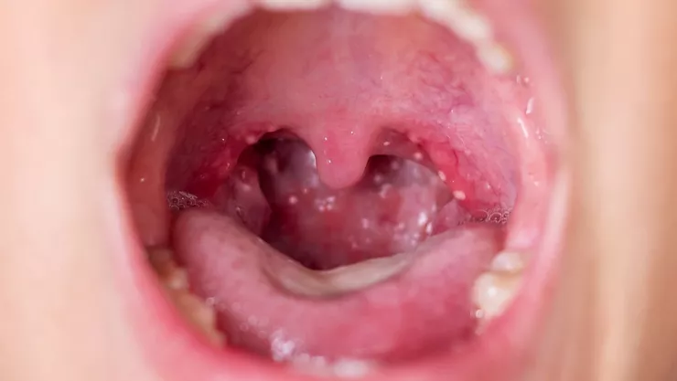 Casos de escarlatina en México y cuáles son los síntomas