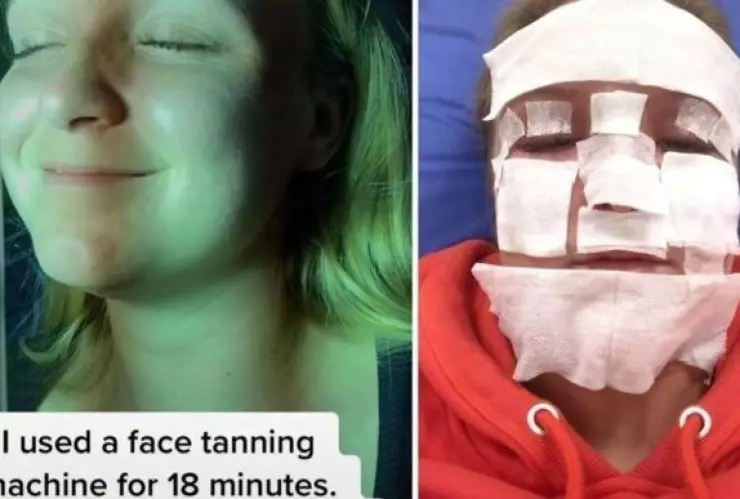 Influencer quemaduras cámara de bronceado