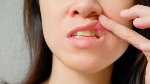 Remedios naturales para las aftas bucales