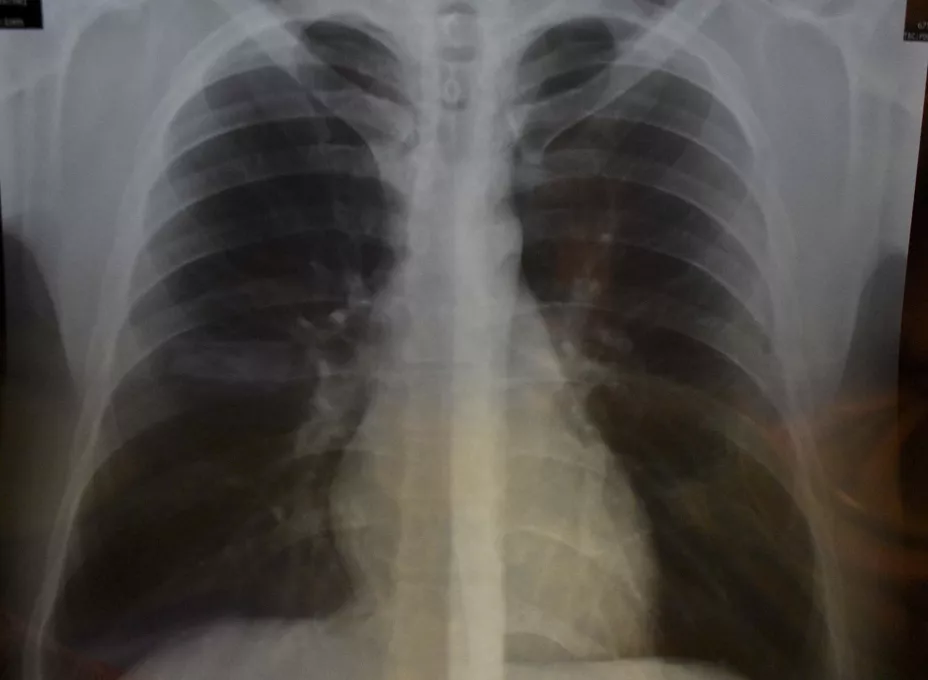 CÁNCER DE PULMÓN.jpg