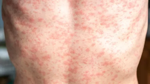 Se incrementa el número de muertes por sarampión a causa del brote