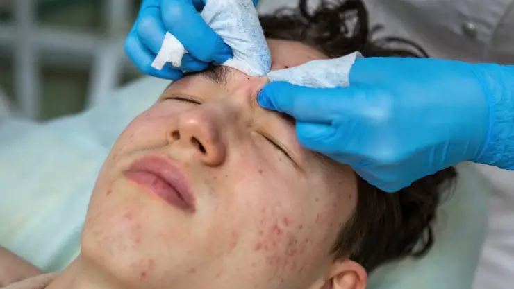 adolescentes en México sufren de acné