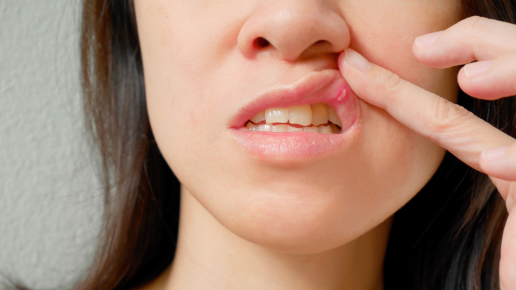 Remedios naturales para las aftas bucales