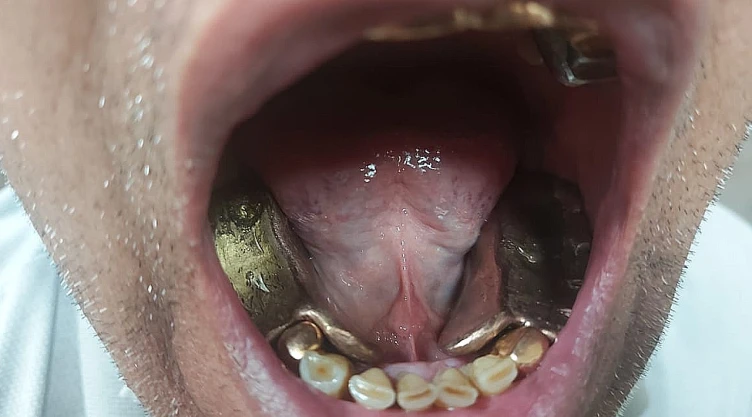 oro_dentadura
