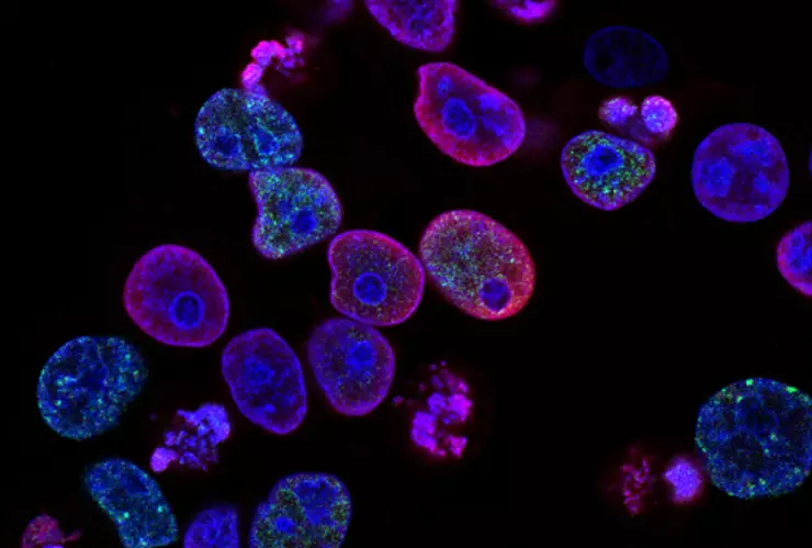 Cáncer de pene: Causas y síntomas de la rara enfermedad