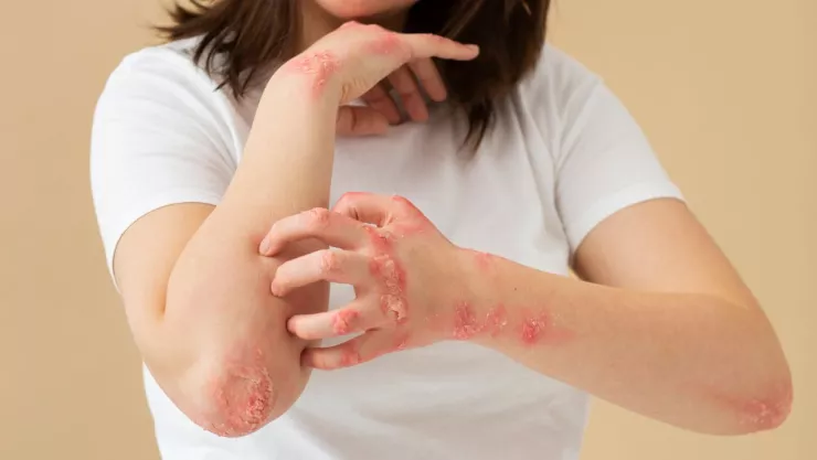 Baja California reporta 231 casos de enfermedad boca-pie-mano