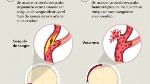 Muerte de Gustavo Cerati: Esto es un accidente cerebro vascular, causa por la que cayó en coma