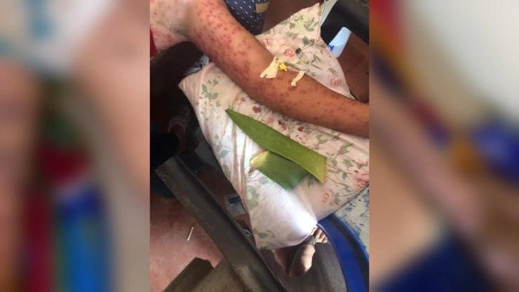 Ataque de abejas africanizadas