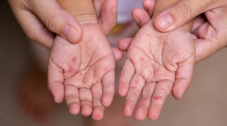 Las manos de un niño con signos de sarampión.