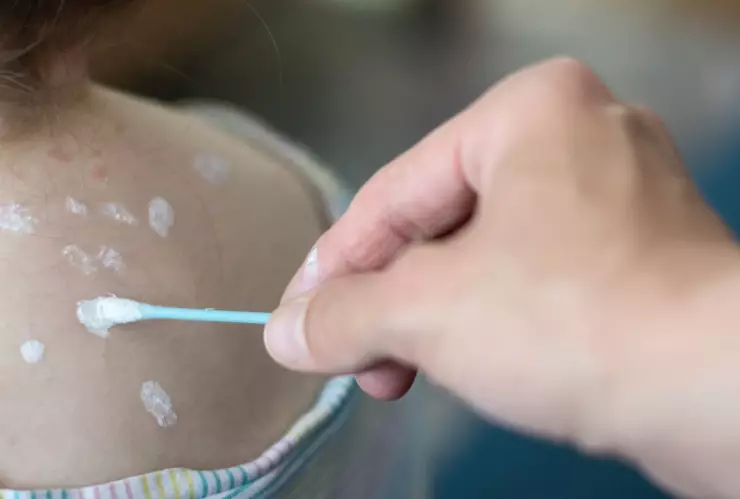 ¿Cómo identificar la viruela del mono y el herpes zóster? Estos son los síntomas