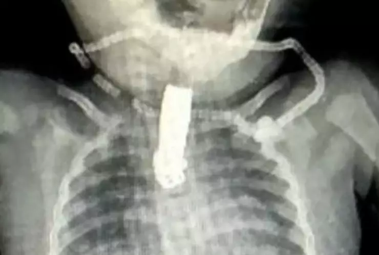 IMÁGENES Una bebé se tragó un cortauñas y se le atoró en la garganta.
