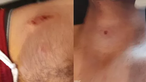 Joven herido por explosion de cuete en Angel R. Cabada