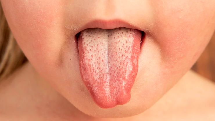 escarlatina en México: ¿Hay Escarlatina en Chiapas? Reportan Casos en Hidalgo y CDMX: Qué es, síntomas y cómo saber si tengo