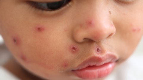 síntomas sarampión