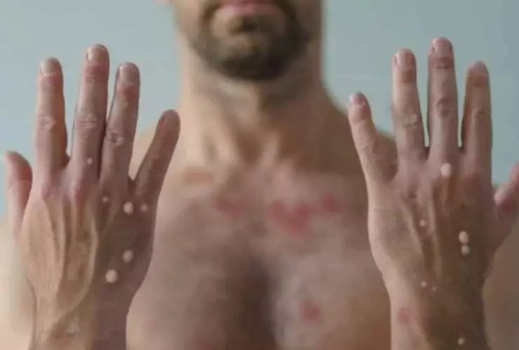 ¡Mucho ojo! Estas son las variantes de la viruela del mono y sus síntomas