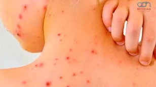  Casos de sarampión en México 