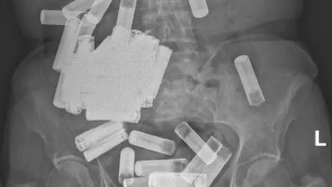 Mujer se traga 55 baterías.jpg