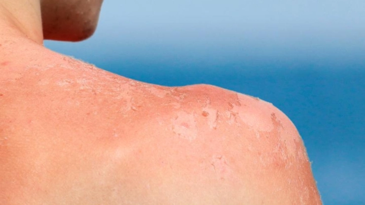 Reportan NUEVO CASO de quemadura solar en Mérida, ya suman 3 en lo que va del 2026