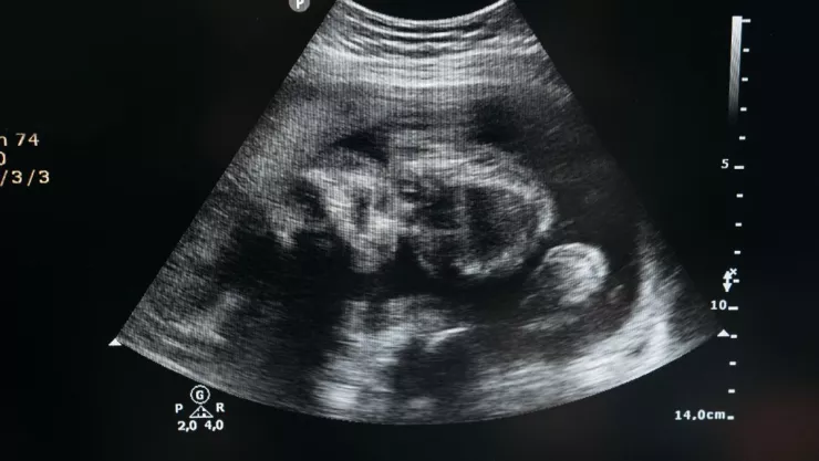 Doctores encuentran fetos en el vientre de una bebé recién nacida