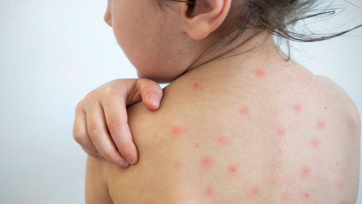 sarampión en Chihuahua