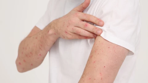 Viruela del mono: Síntomas de la cepa que mantiene en alerta a la OMS por su expansión