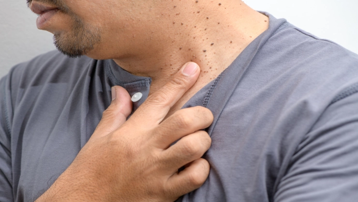 ¿Qué significa cuando me salen verrugas en el cuello?