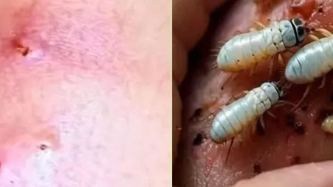 Infección por gusano barrenador en humano enciende alarmas sanitarias