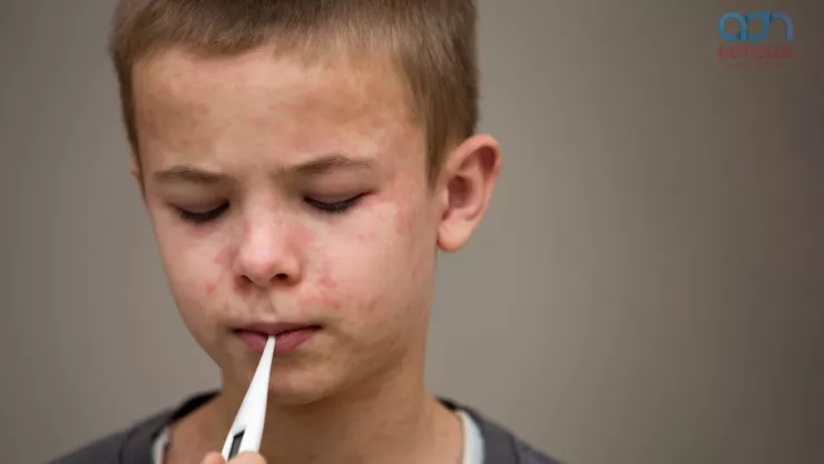 Especialista: Personas con sarampión podrían perder la audición