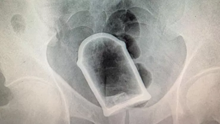 Número de personas hospitalizadas por introducir objetos extraños en el recto