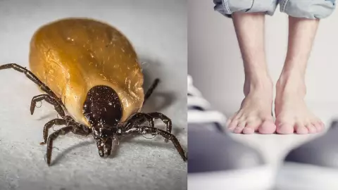 Le amputan todos los dedos del pie por picadura de garrapata