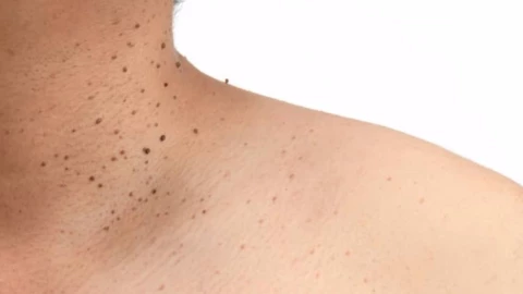 verrugas que son.jpg