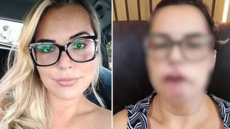 Influencer pierde los labios