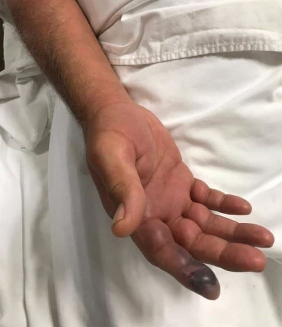 Hombre confunde a víbora de cascabel y lo muerde