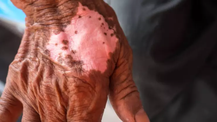 Suman 64 casos de lepra en México, este es el estado con más enfermos