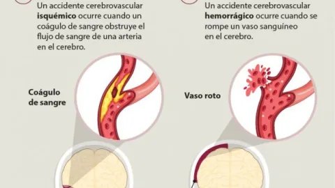Muerte de Gustavo Cerati: Esto es un accidente cerebro vascular, causa por la que cayó en coma