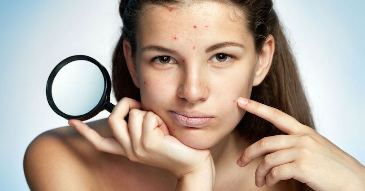 Acné inversa o Hidradenitis Supurativa