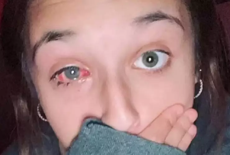 Adolescente queda ciega de un ojo tras explotarle tinte de cabello.jpg