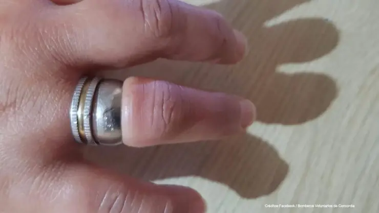 anillo atorado dedo mujer.jpg