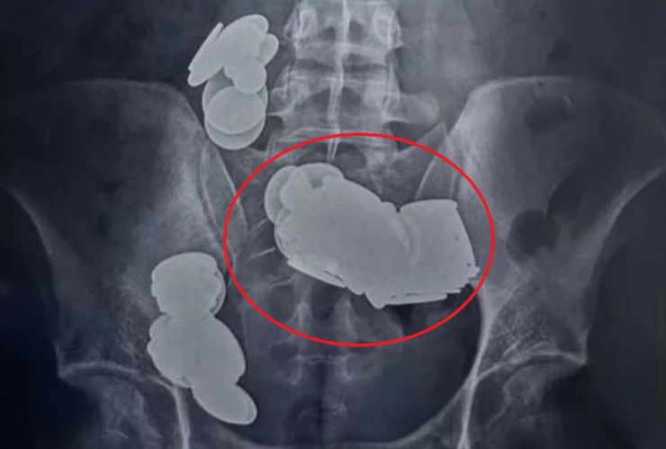 joven se traga monedas e imanes india