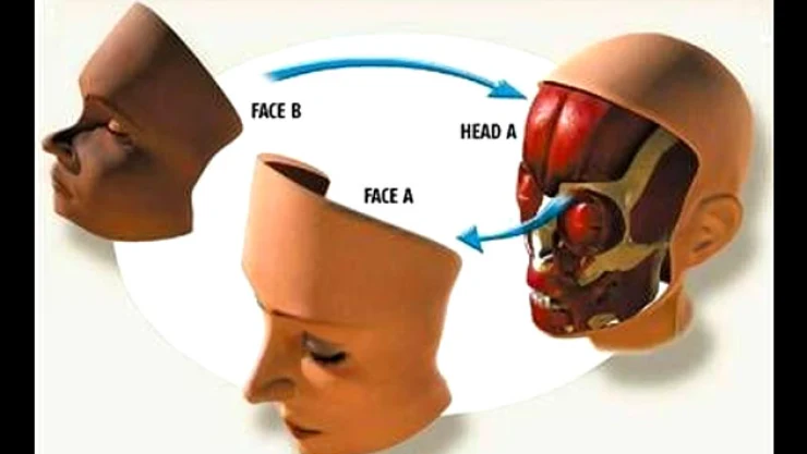 Hospital de Boston realiza trasplante de rostro