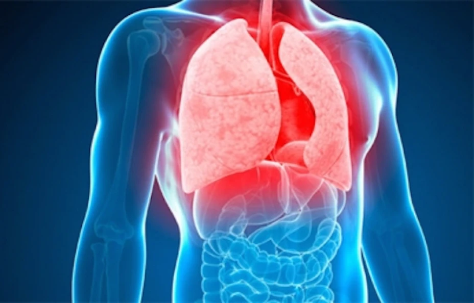 Tratamiento tuberculosis