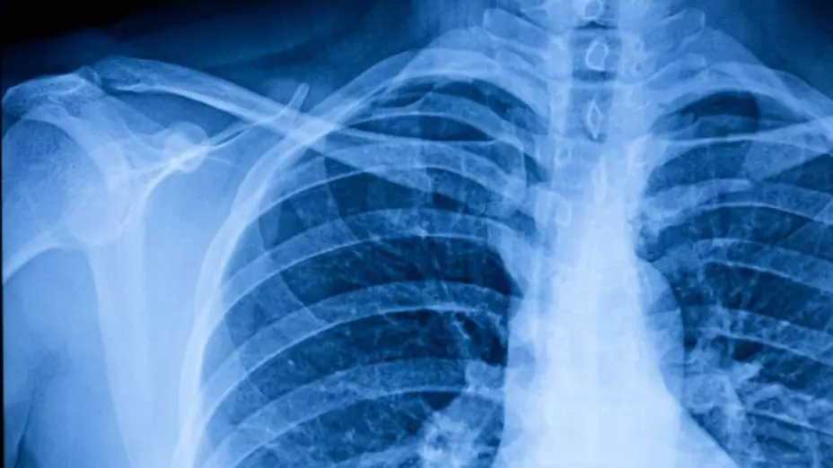 UNAM lanza taller de rehabilitación pulmonar post Covid-19.
