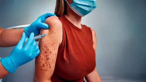 Casos de sarampión en Tabasco por municipio: Centro y Nacajuca, los más afectados