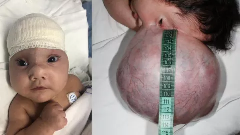 Realizan primera cirugía de malformación neonatal de cráneo con éxito a una bebé prematura