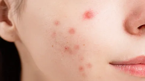 Así puedes ocultar un grano inflamado, usando solo maquillaje
