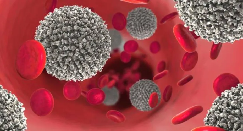 Cáncer Hematológico LMA.jpg